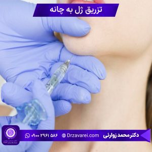 تزریق ژل به چانه